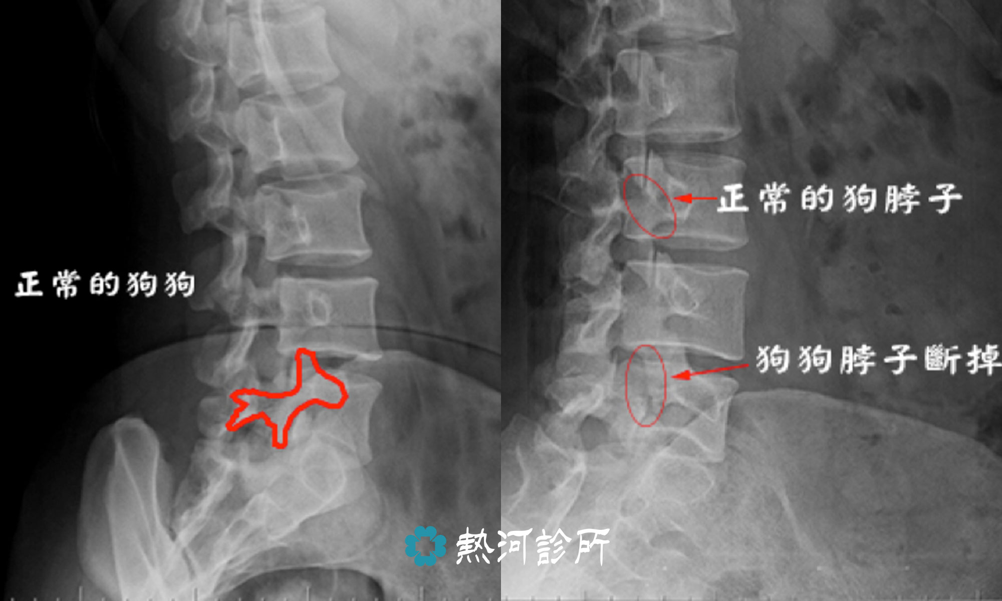 椎弓解離 椎弓解離怎麼治療 需要開刀脊椎手術嗎 熱河診所