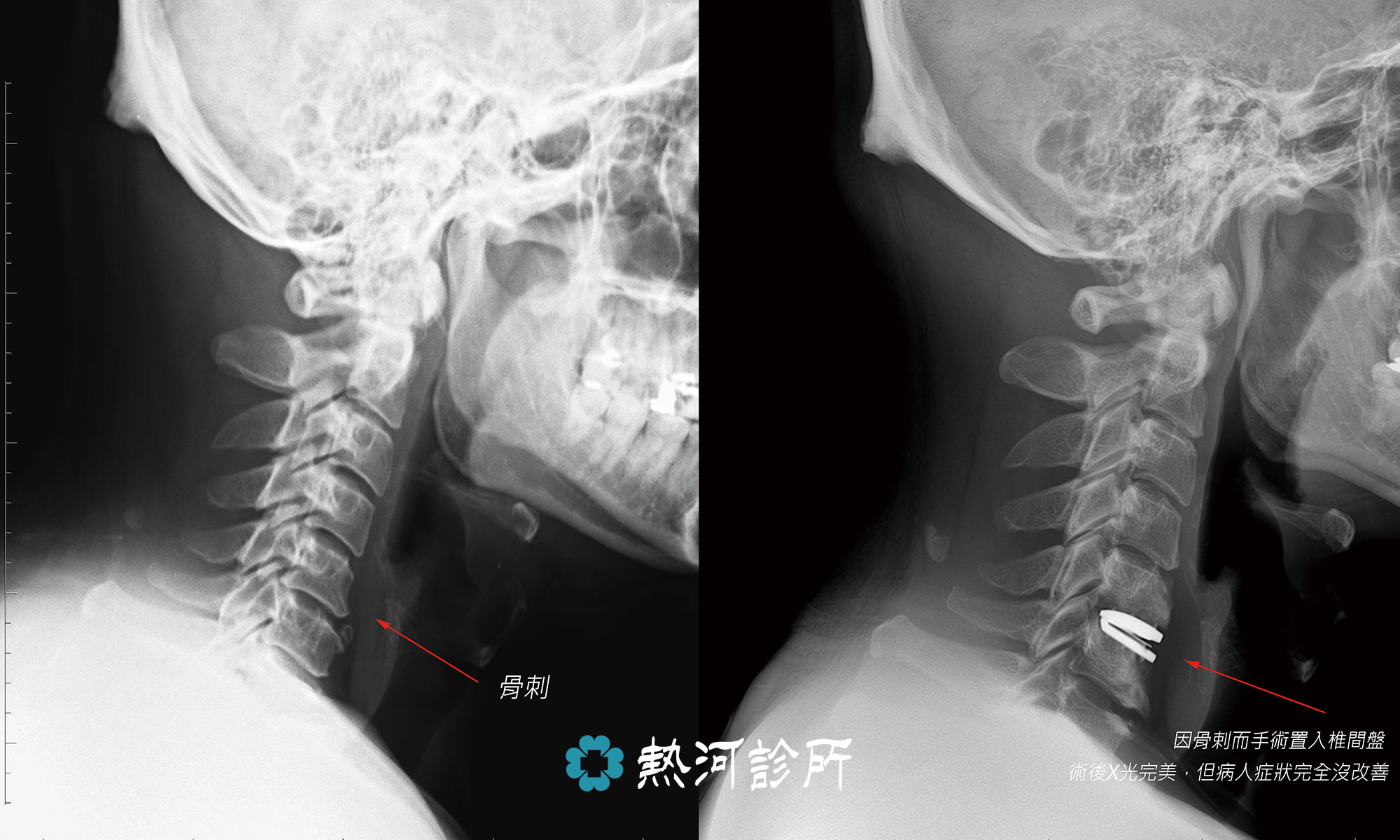 肩頸彙整 熱河診所 高雄骨科 高雄醫美 高雄植髪