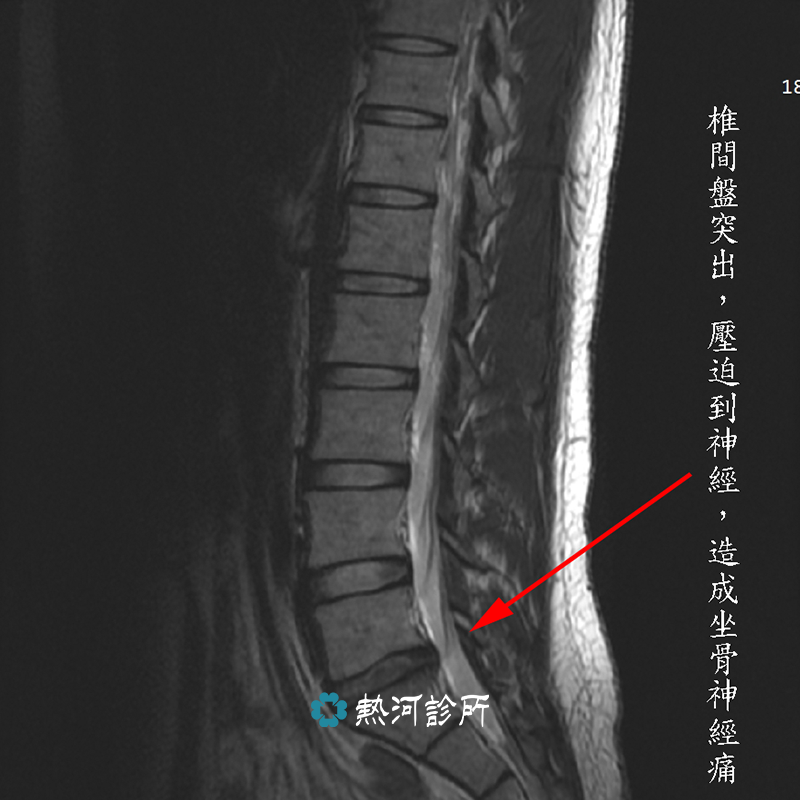 骨骼肌肉超音波 精準疼痛治療 超音波導引 熱河診所