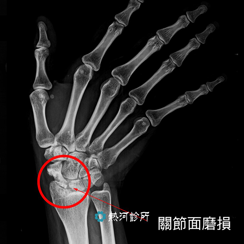 手腕骨折 久治不癒的手腕痛 要小心隱藏的舟狀骨骨折 熱河診所