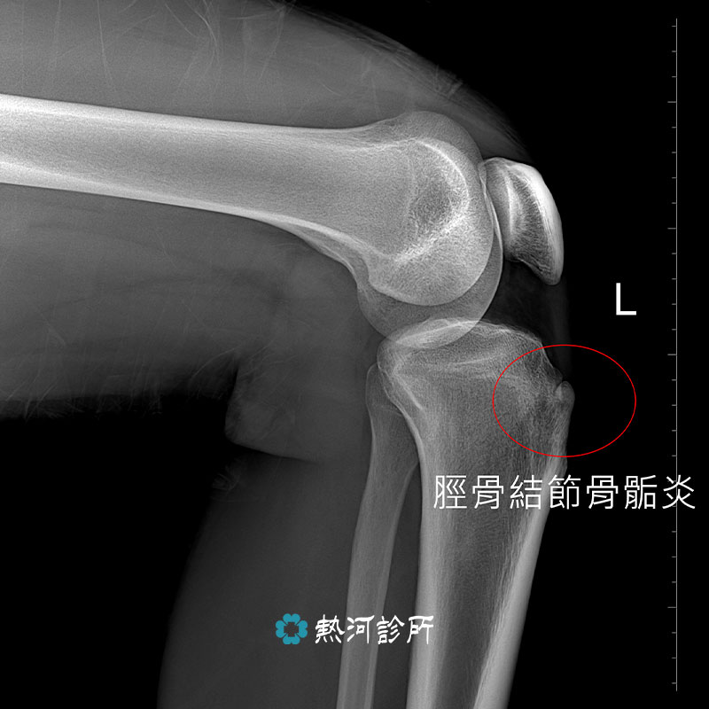 骨骼肌肉超音波 精準疼痛治療 超音波導引 熱河診所