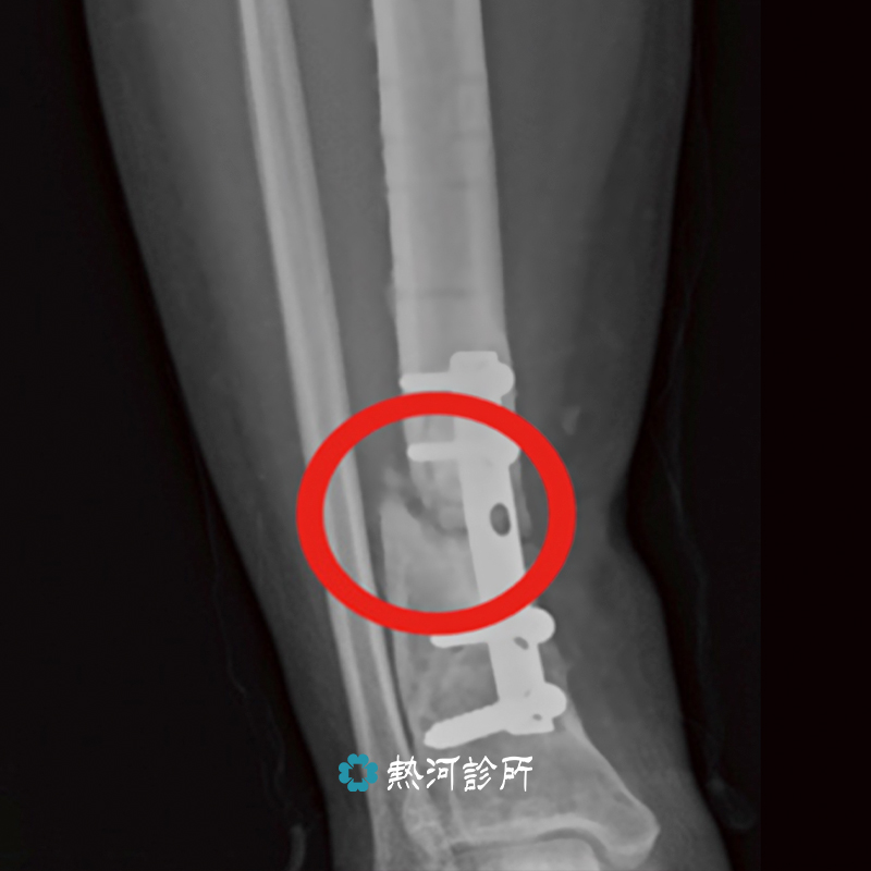 脛骨骨折 小腿脛骨骨折癒合 重拾雙腳走路的喜悅 熱河診所