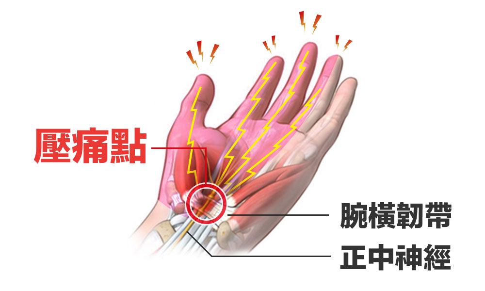 腕隧道症候群| 手麻手痛好困擾，現代常見職業病| 熱河診所